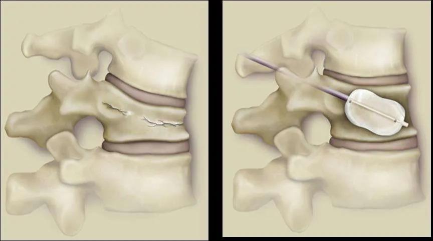 椎体压缩优发国际性骨折的球囊扩张技术有哪些作用呢